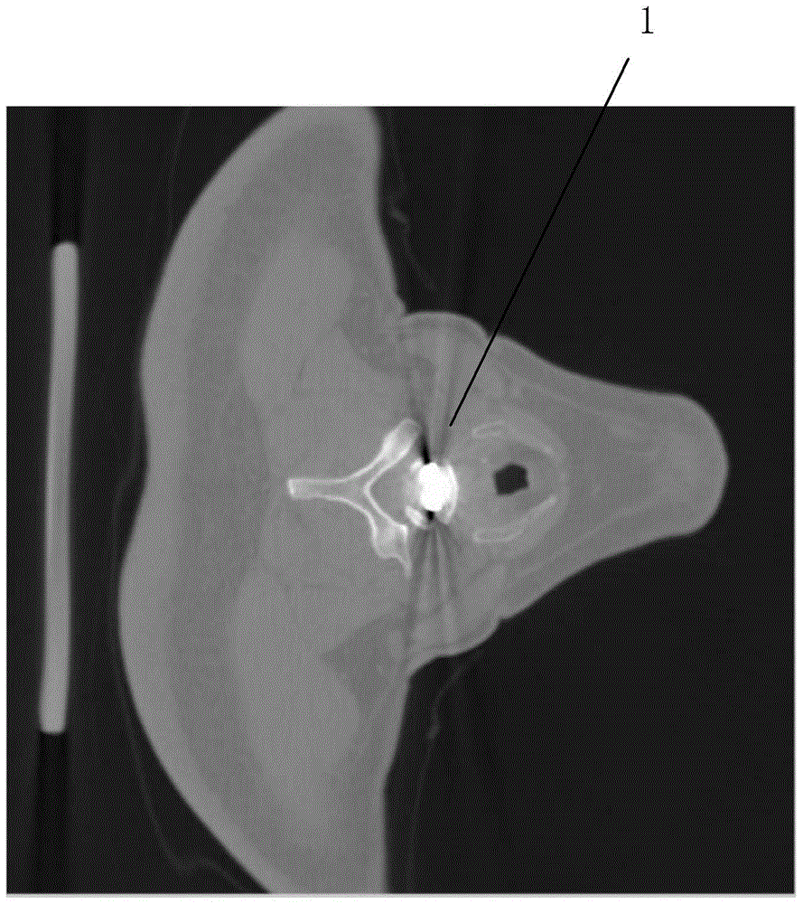 Method of removing metal artifact from CT image