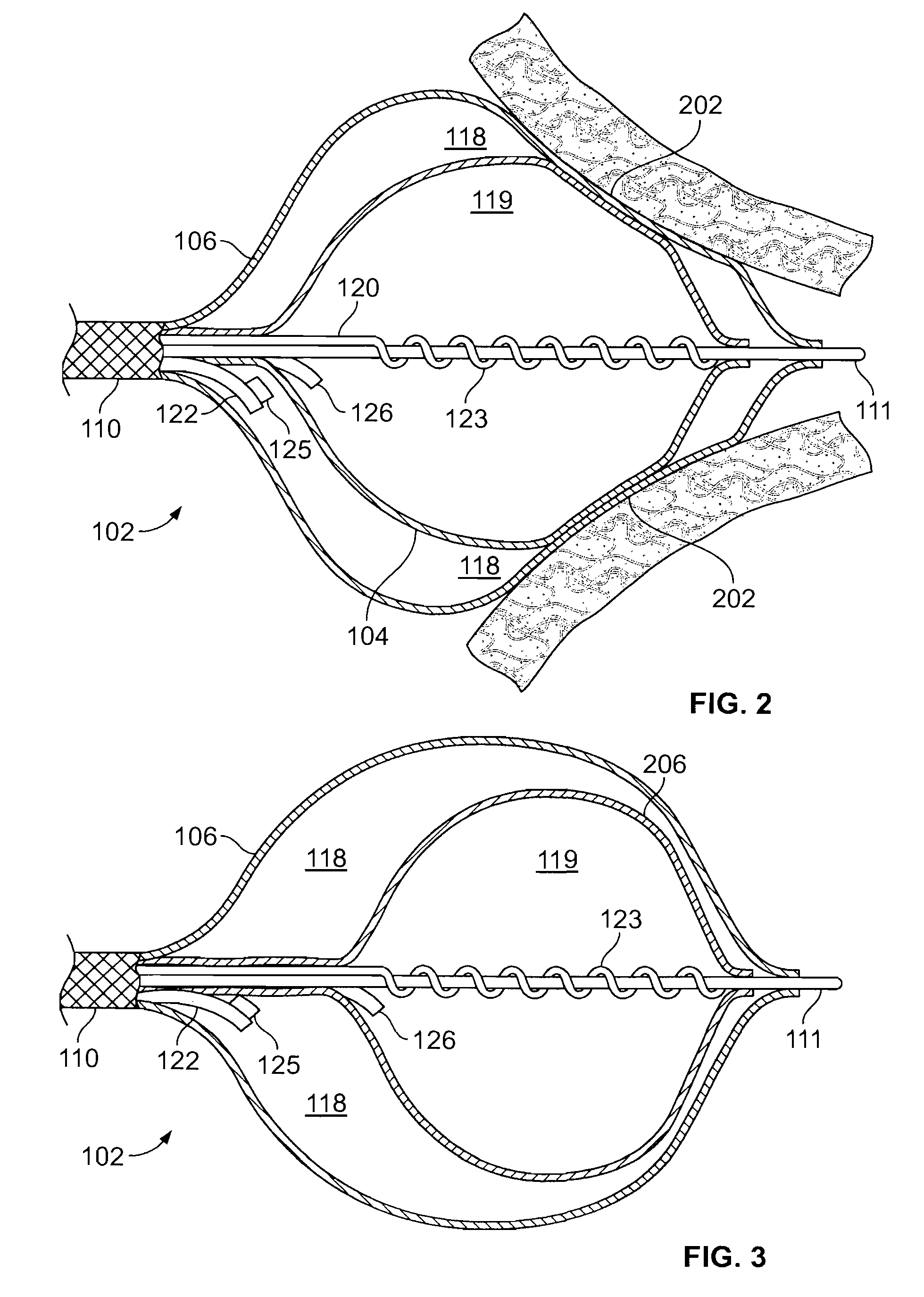 Nested balloon cryotherapy