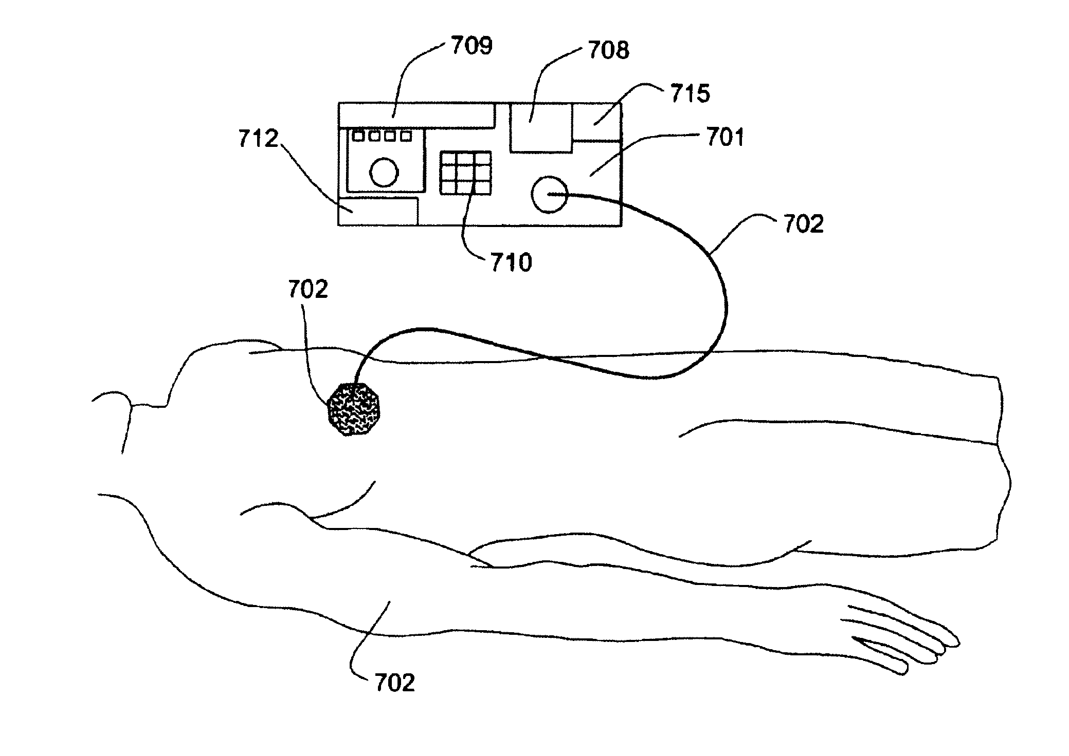 Method and apparatus for quasi-fractional intense pulse light resurfacing