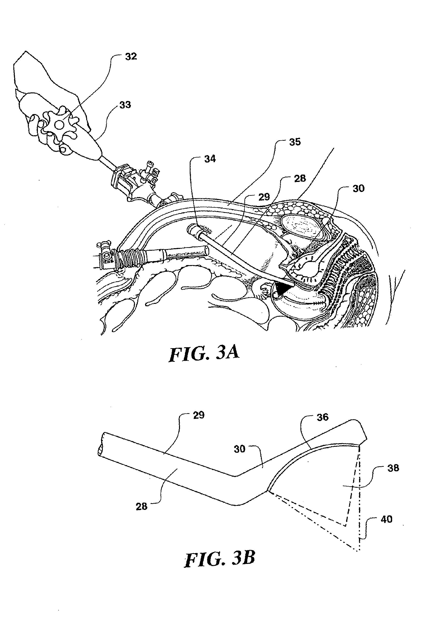 Controlled high efficiency lesion formation using high intensity ultrasound