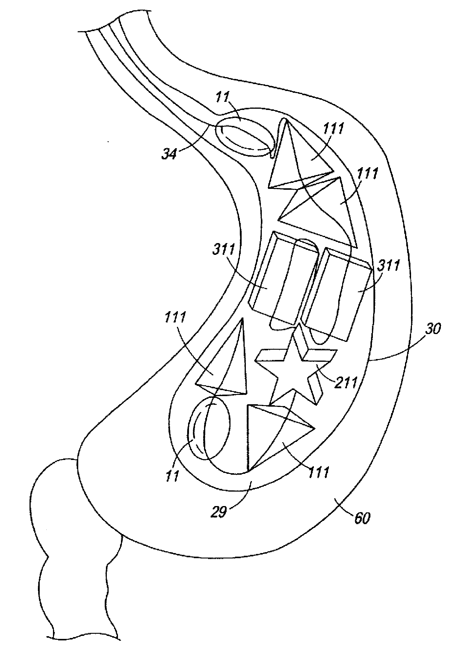 Intragastric bag for treating obesity