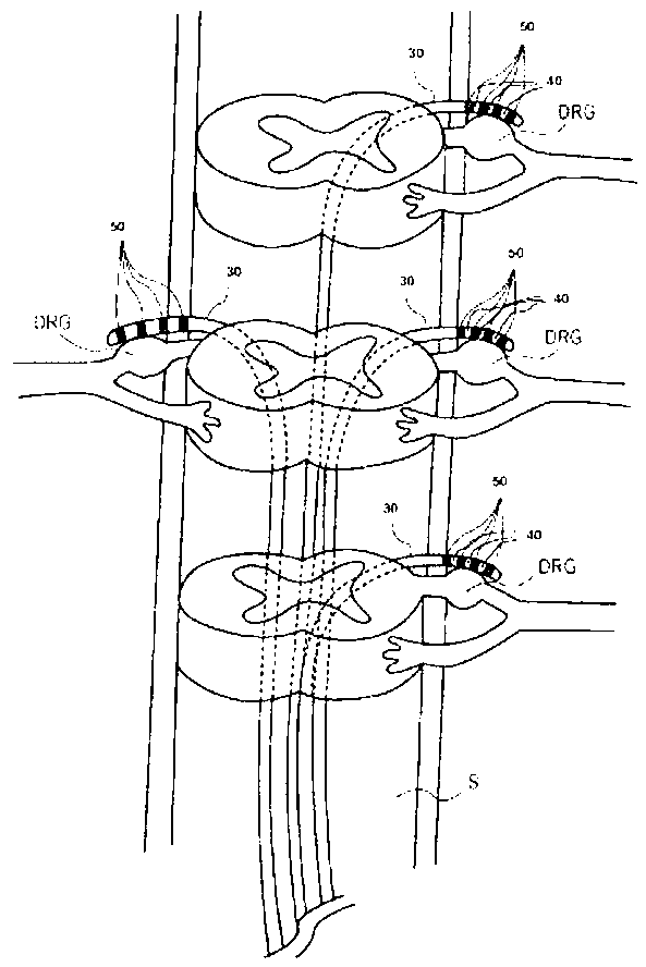 Directed delivery of agents to neural anatomy