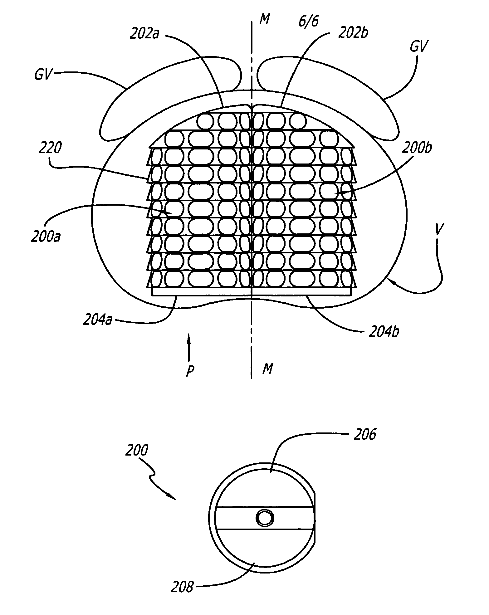 Arcuate artificial hemi-lumbar interbody spinal fusion implant having an asymmetrical leading end