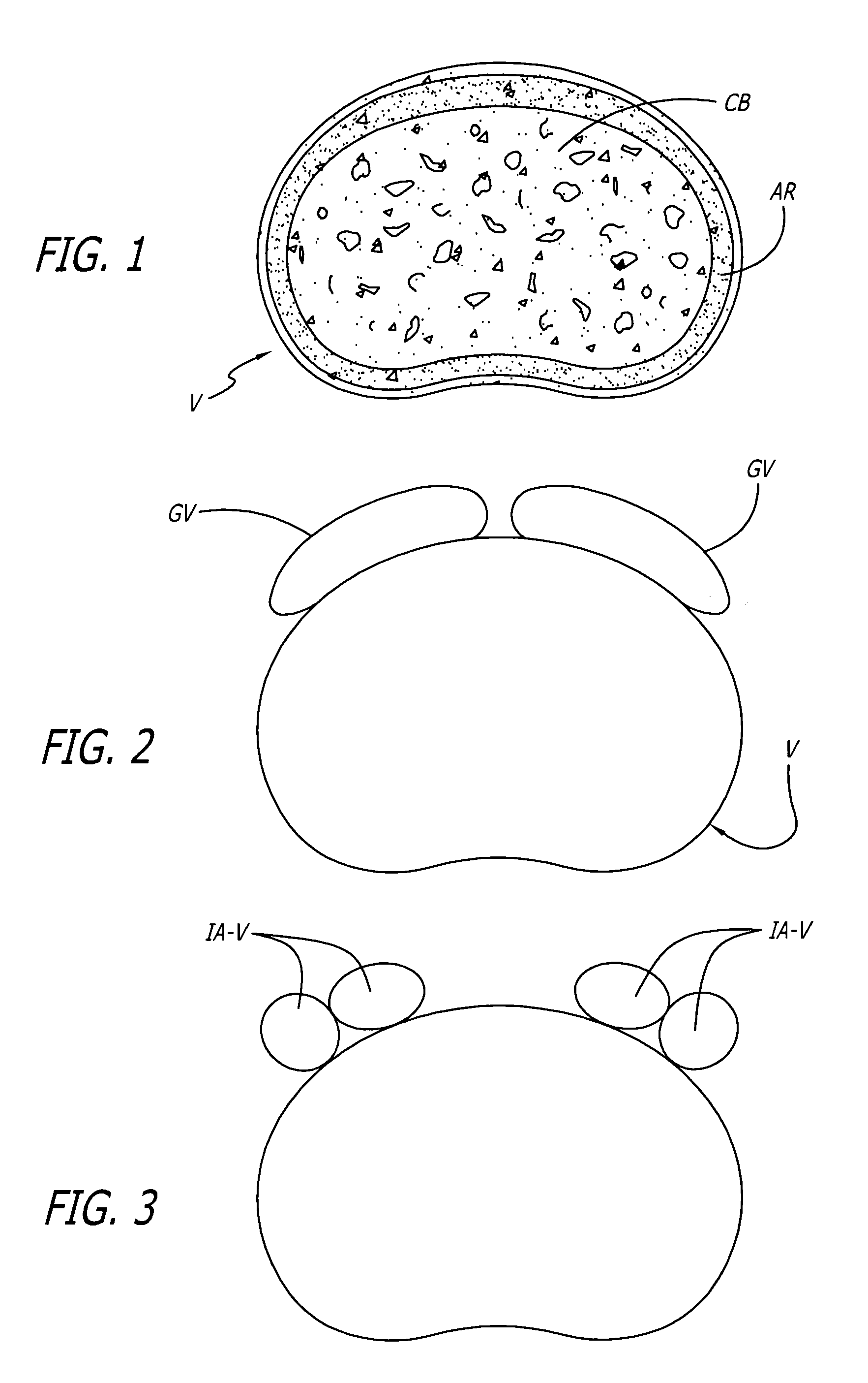 Arcuate artificial hemi-lumbar interbody spinal fusion implant having an asymmetrical leading end