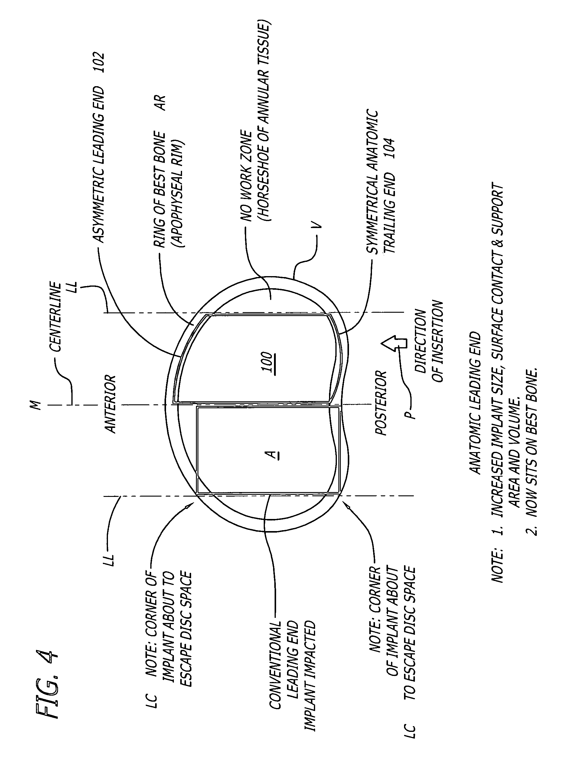 Arcuate artificial hemi-lumbar interbody spinal fusion implant having an asymmetrical leading end