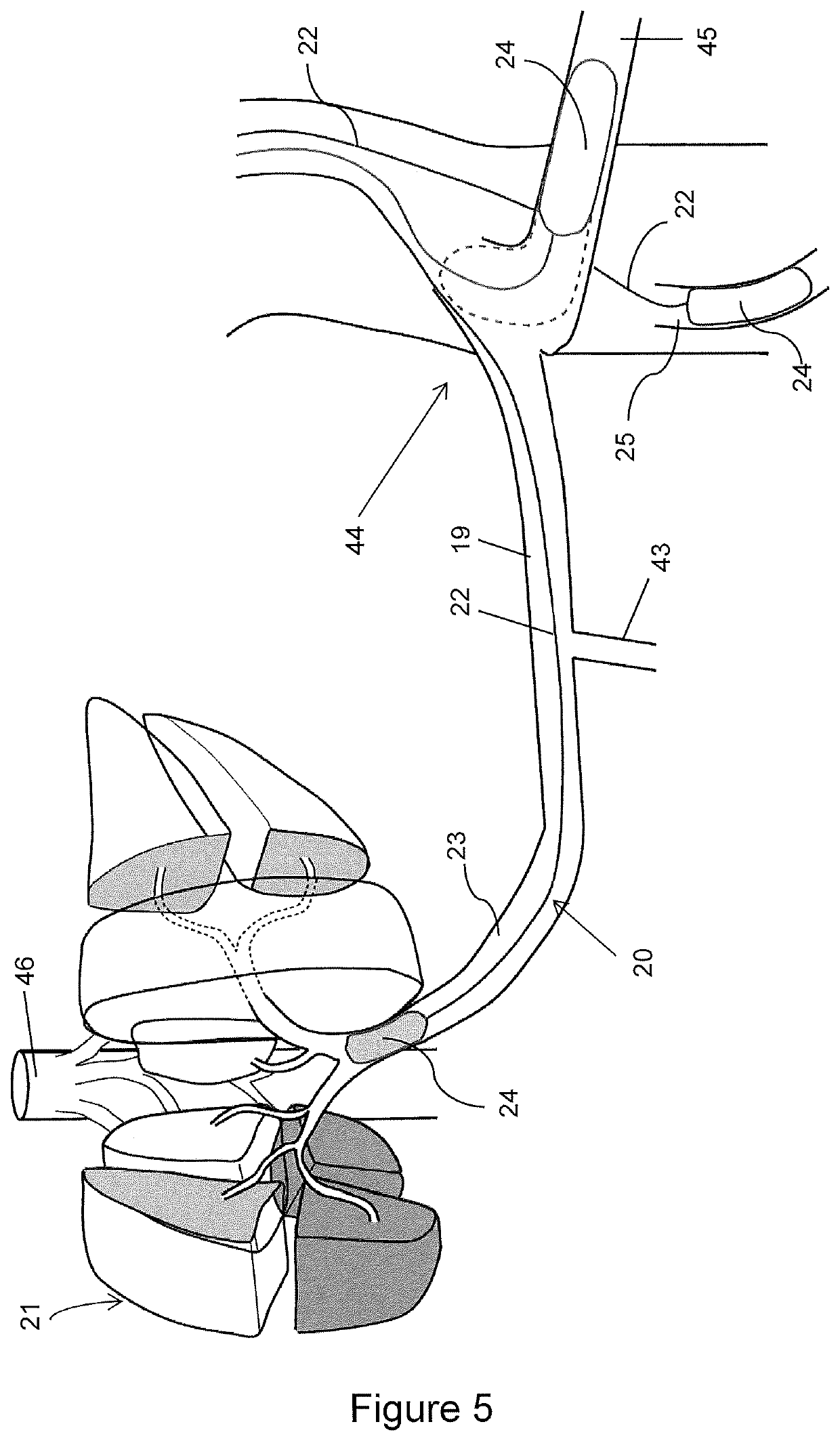 Devices and Methods for Vascular Hyperperfusion of Extravascular Space