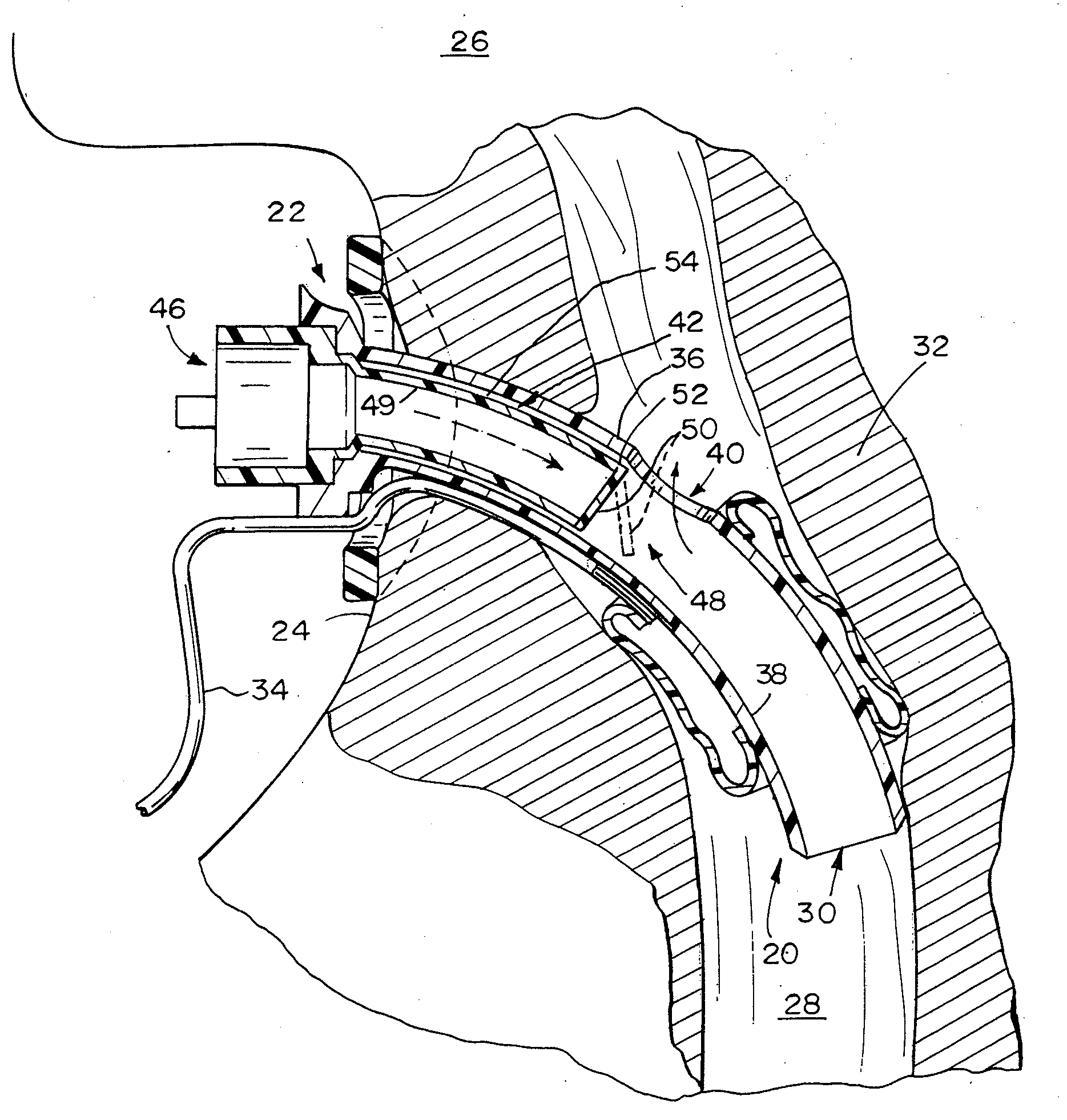 Speaking valve