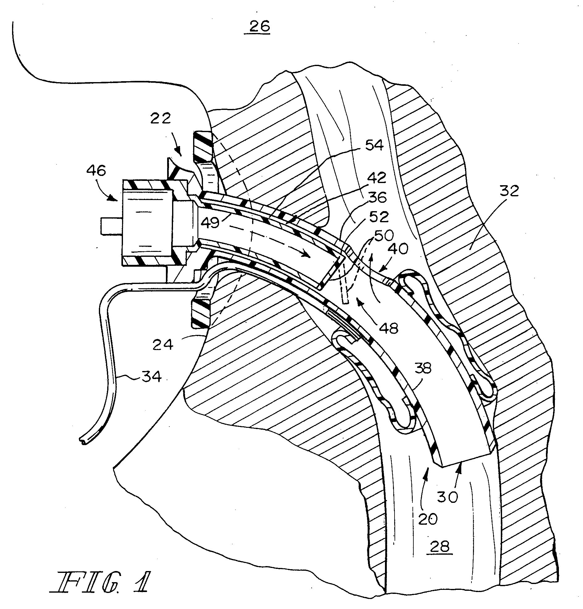 Speaking valve