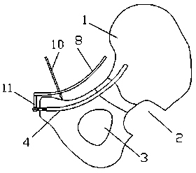 Pelvic fracture microinvasive intramedullary fixation device