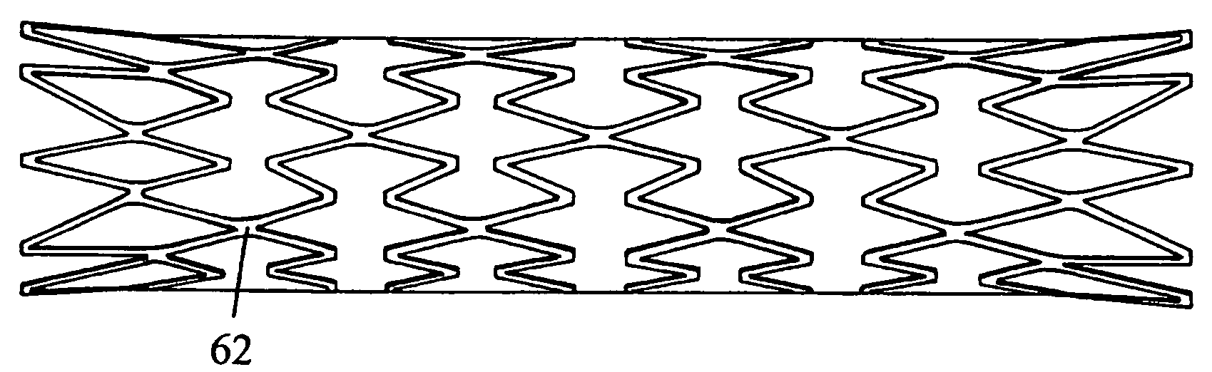 Mri Compatible Implant Comprising Electrically Conductively Closed Loops