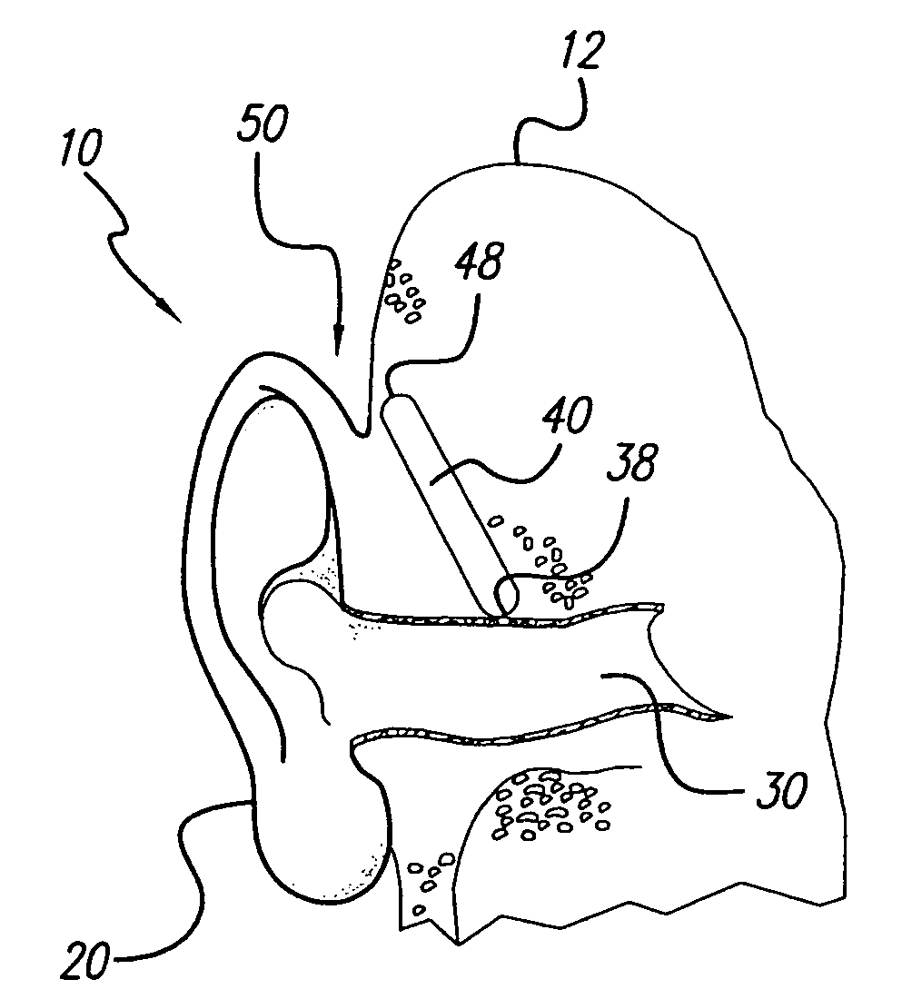 Implanted outer ear canal hearing aid