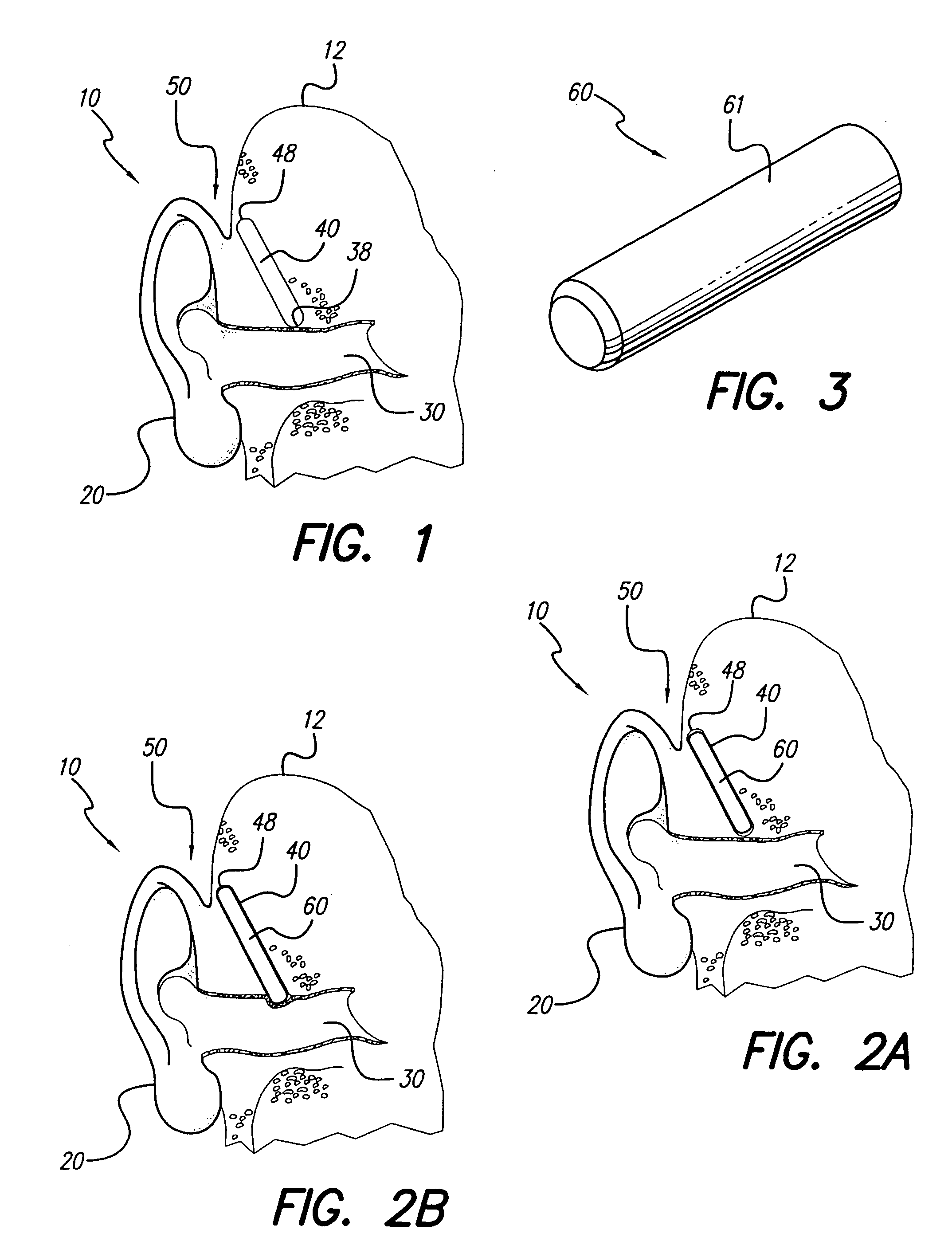 Implanted outer ear canal hearing aid