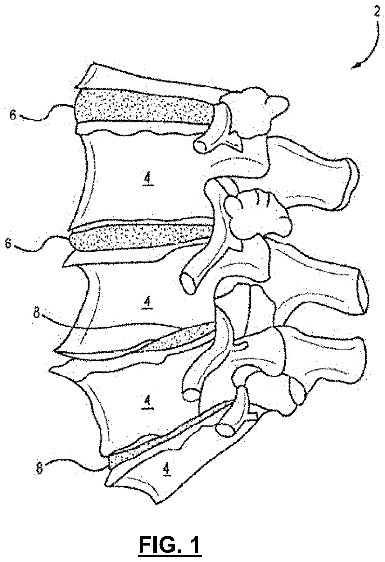 Hybrid spinal cages, systems and methods