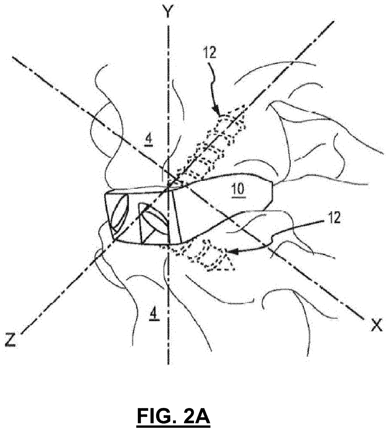 Hybrid spinal cages, systems and methods