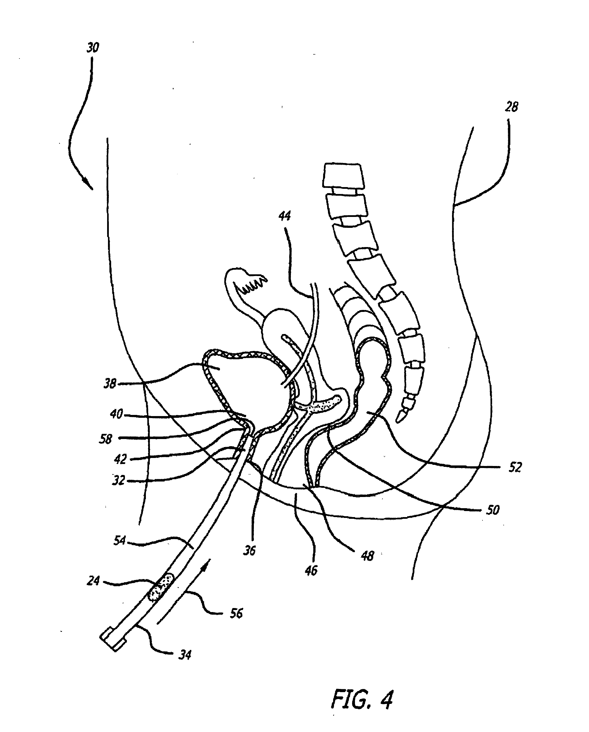 Transluminal drug delivery methods and devices