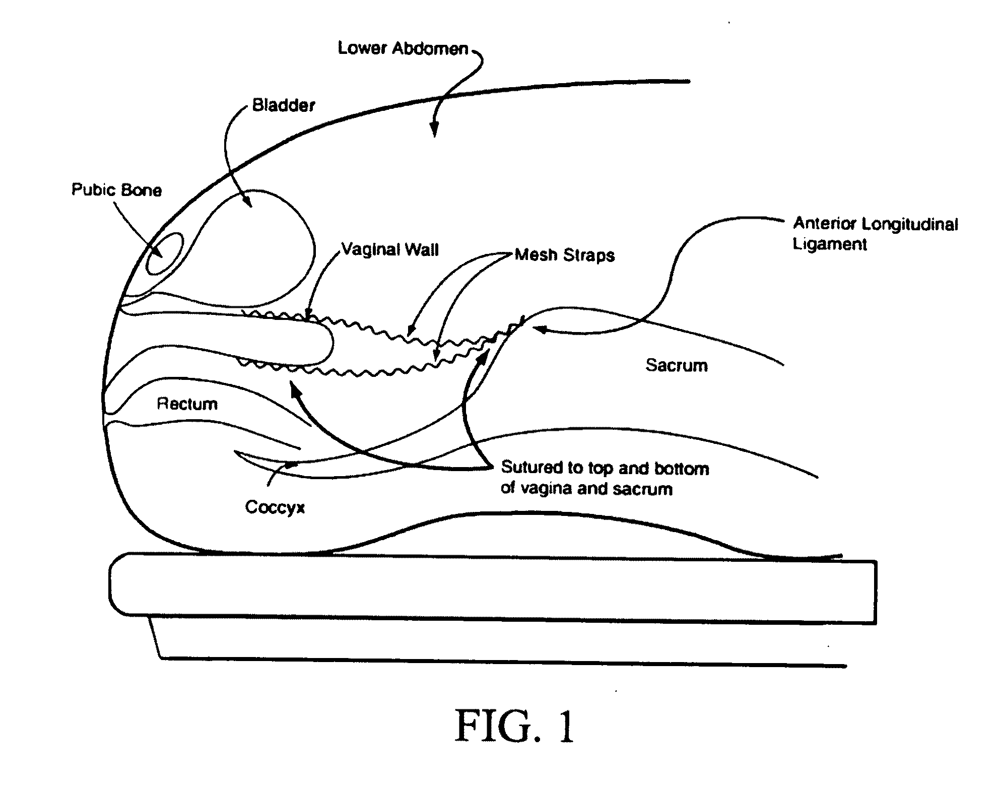 Adjustable sacral mesh fixation device and method