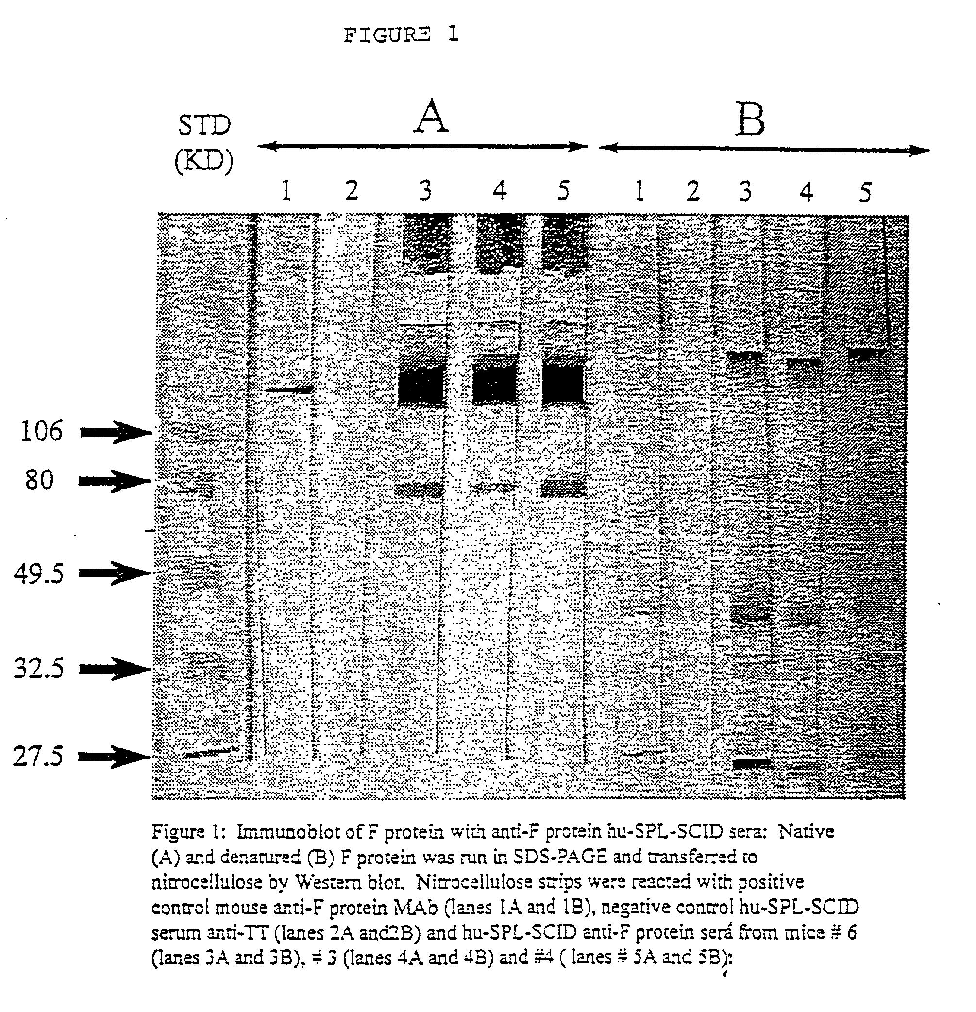 Neutralizing high affinity human monoclonal antibodies specific to RSV F-protein and methods for their manufacture and therapeutic use thereof