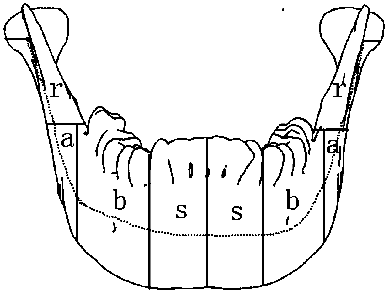 PEKK individualized implant design and manufacture method for reconstruction of mandible box defect and implant