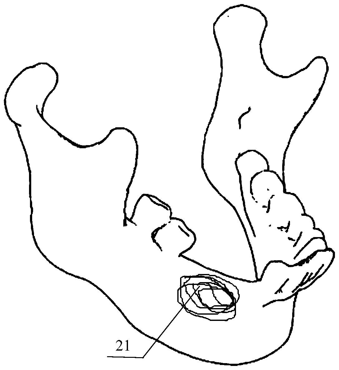 PEKK individualized implant design and manufacture method for reconstruction of mandible box defect and implant