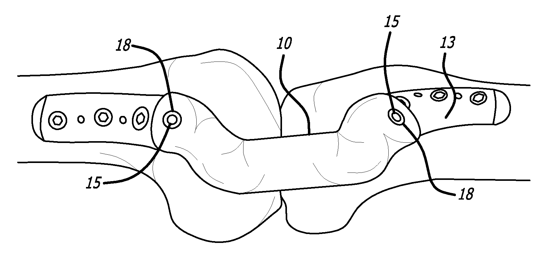 Sheaths for extra-articular implantable systems