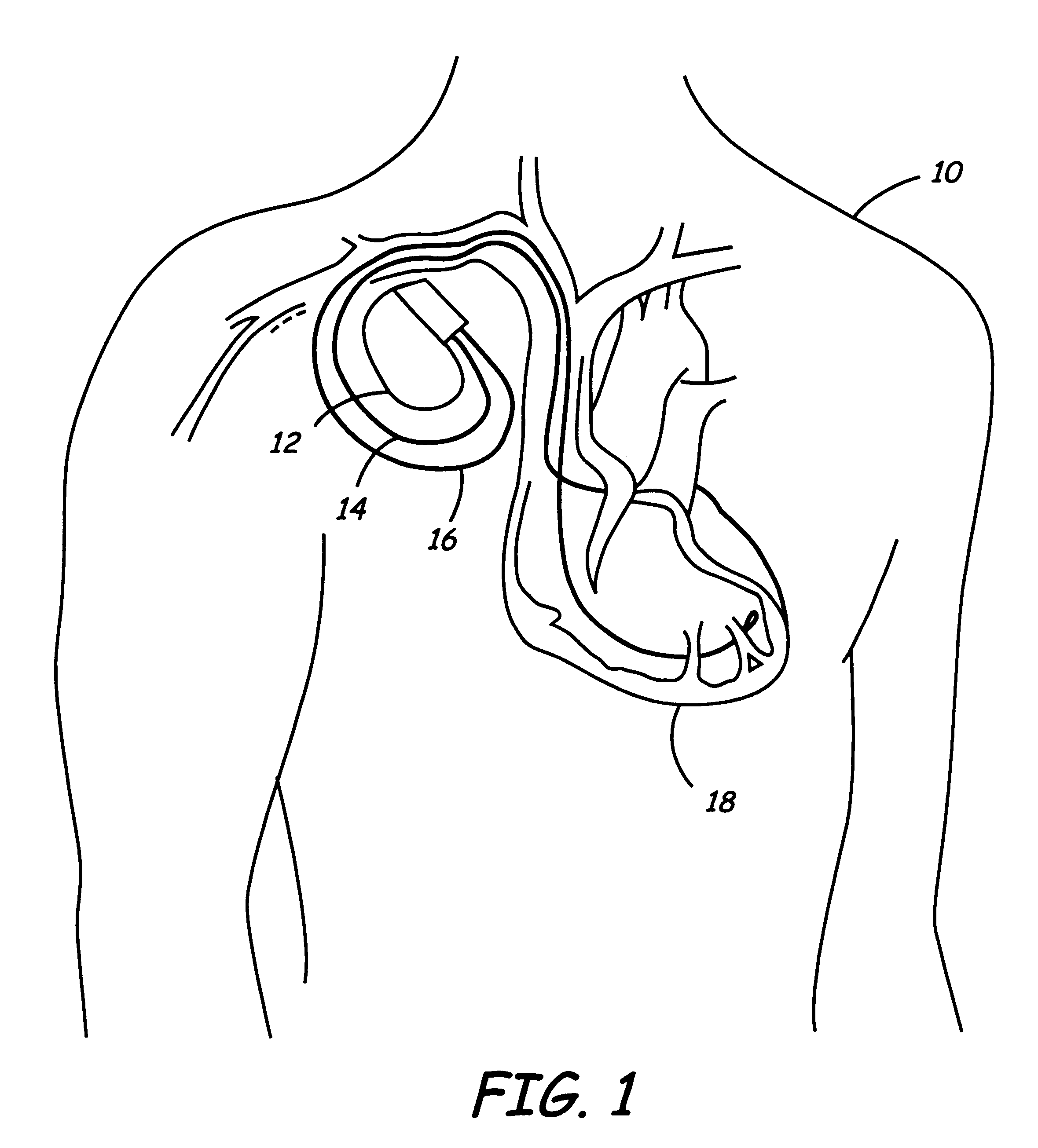 Co-extruded, multi-lumen medical lead