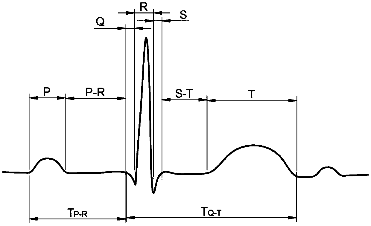 Electrocardiosignal (ECG) analysis method for wearable intelligent underwear