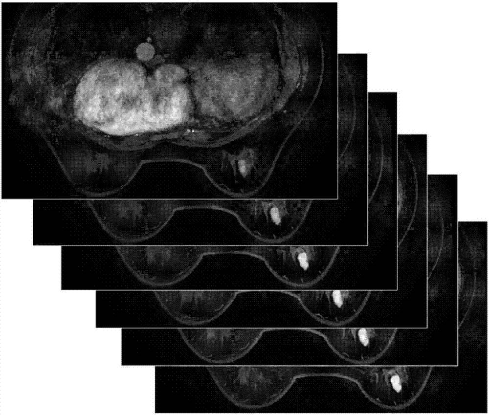 MRF-Snake segmentation-based breast cancer diagnosis system and method