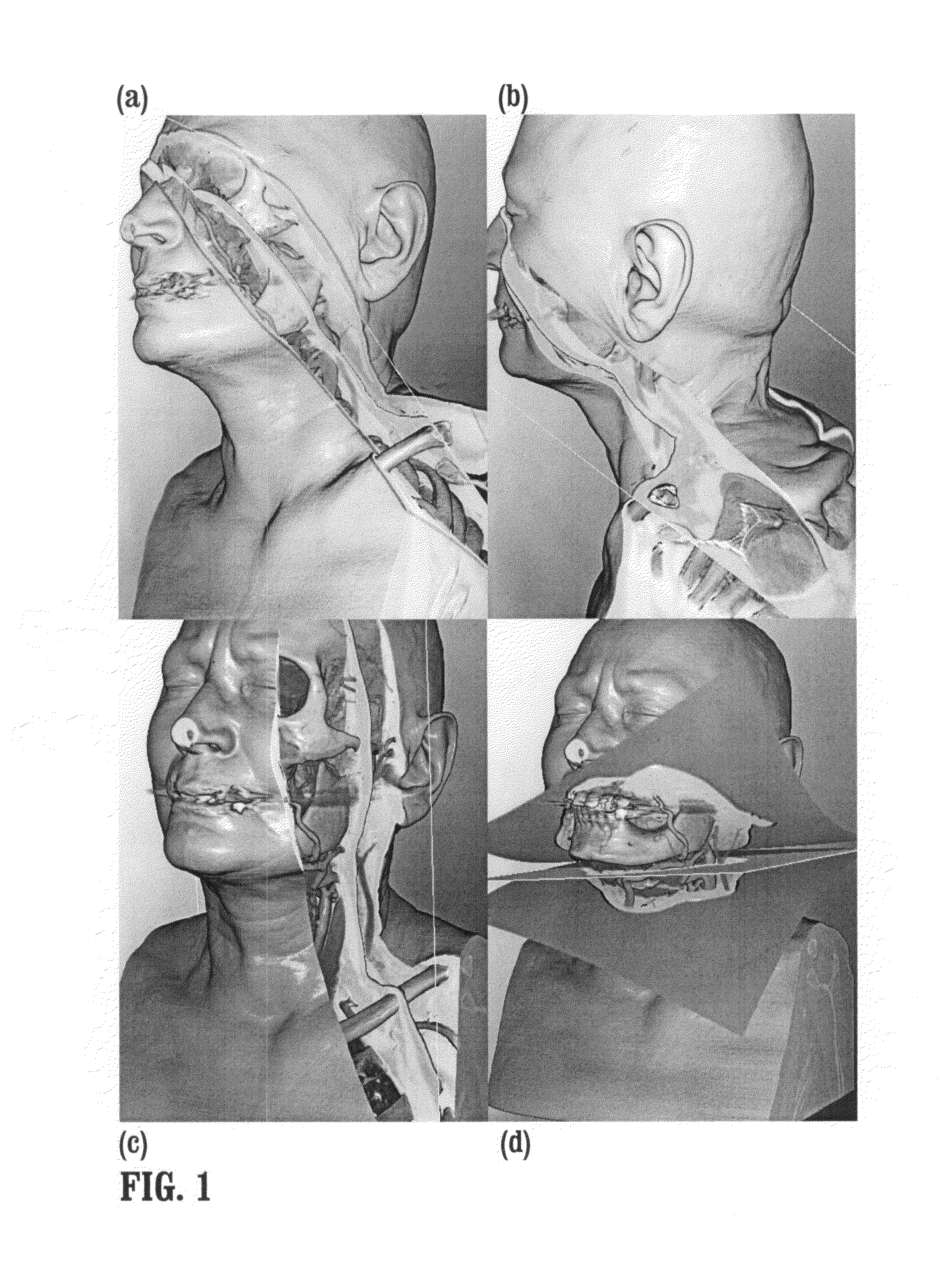 System and method for in-context MPR visualization using virtual incision volume visualization