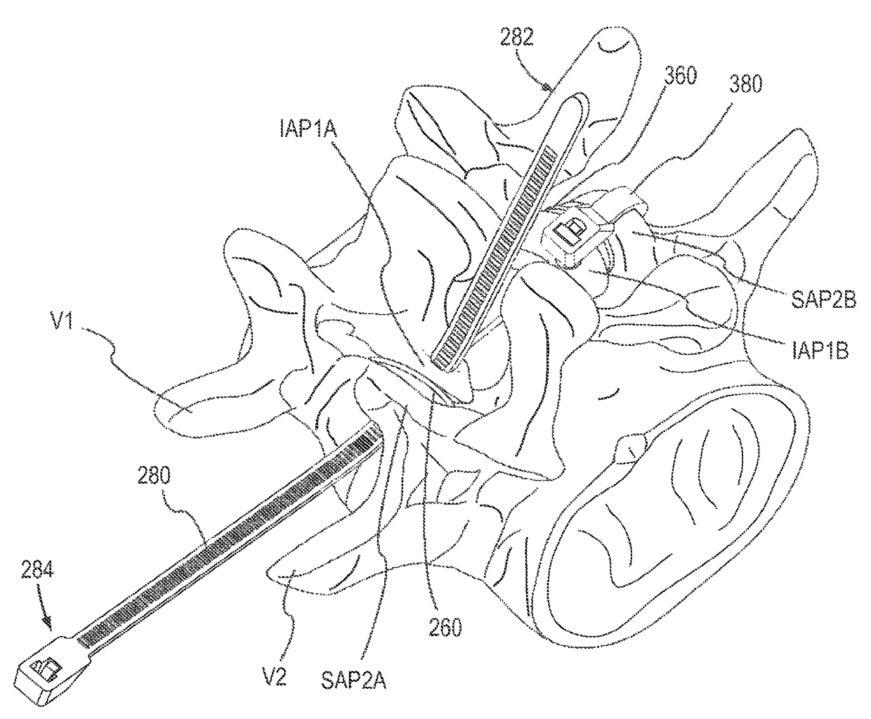 Device and method for reinforcement of a facet