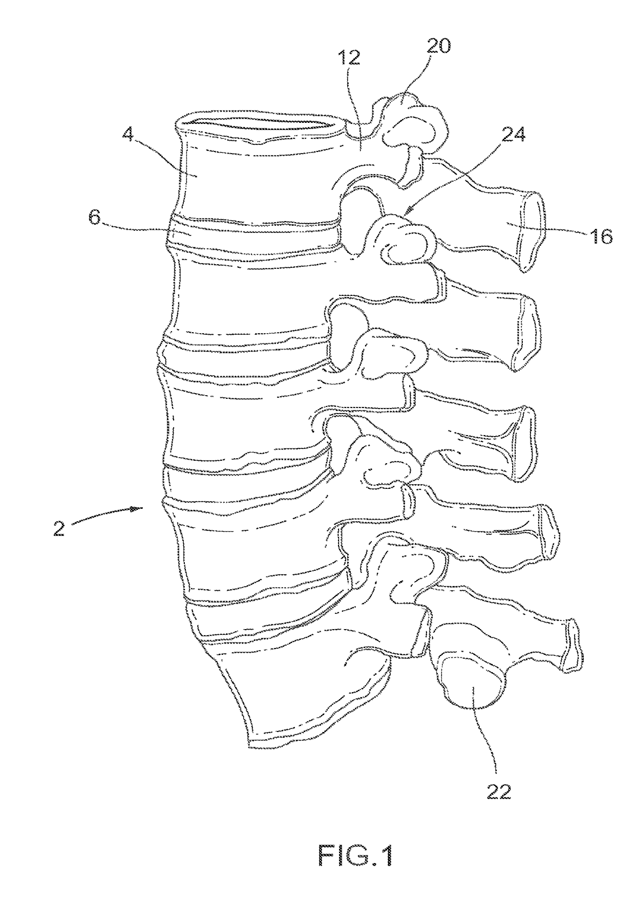 Device and method for reinforcement of a facet