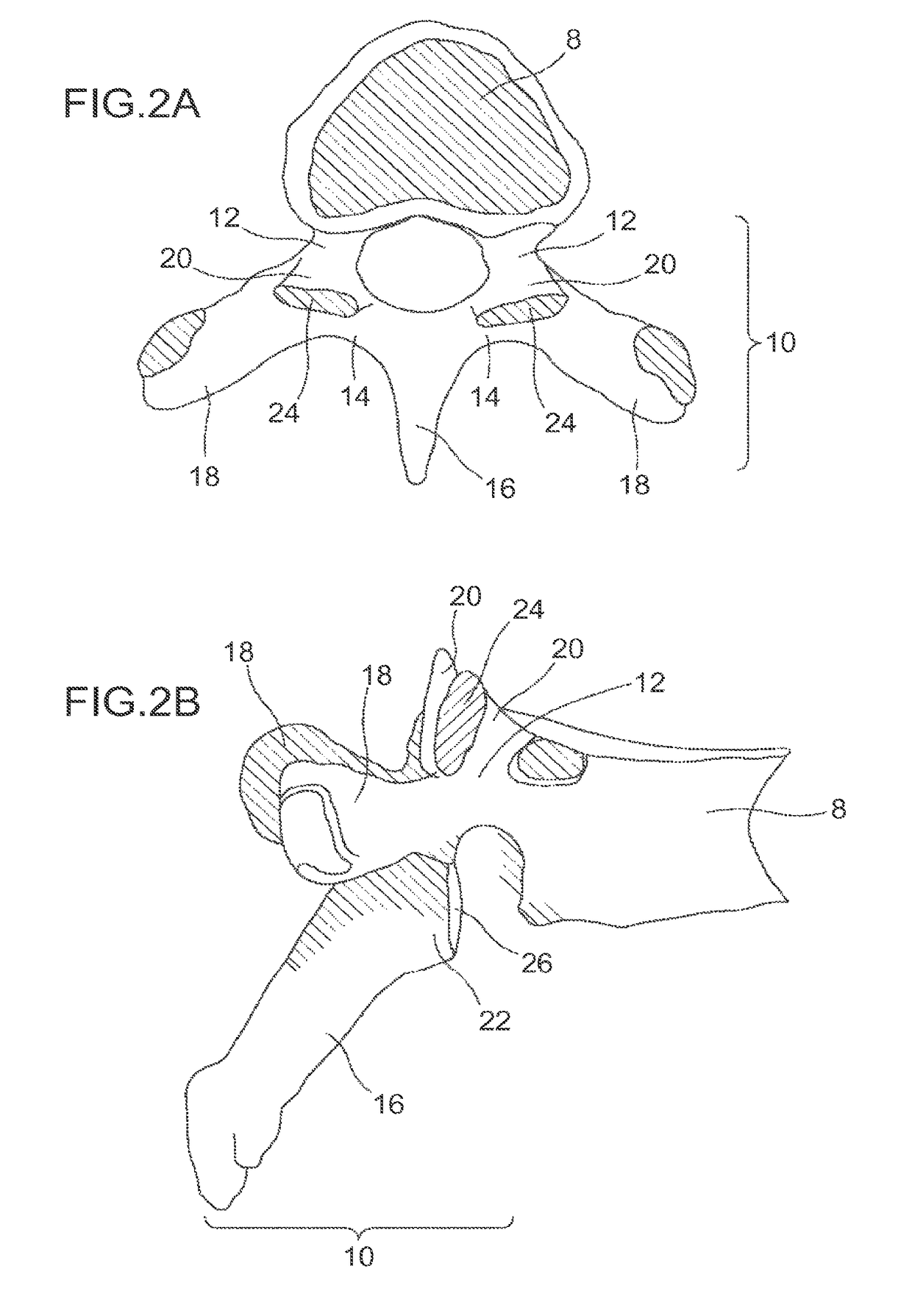 Device and method for reinforcement of a facet