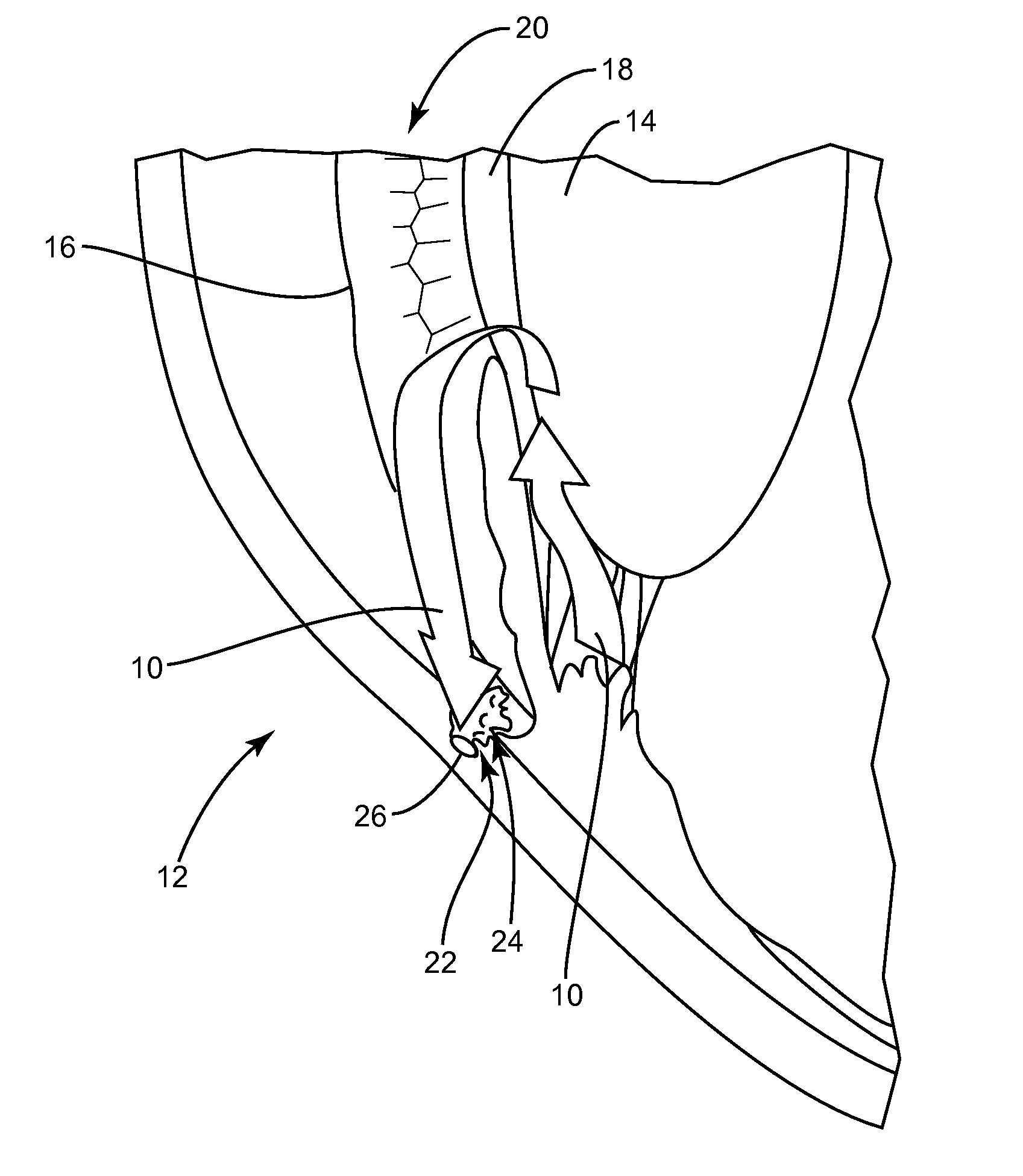 Methods, apparatuses, and systems for reducing intraocular pressure as a means of preventing or treating open-angle glaucoma