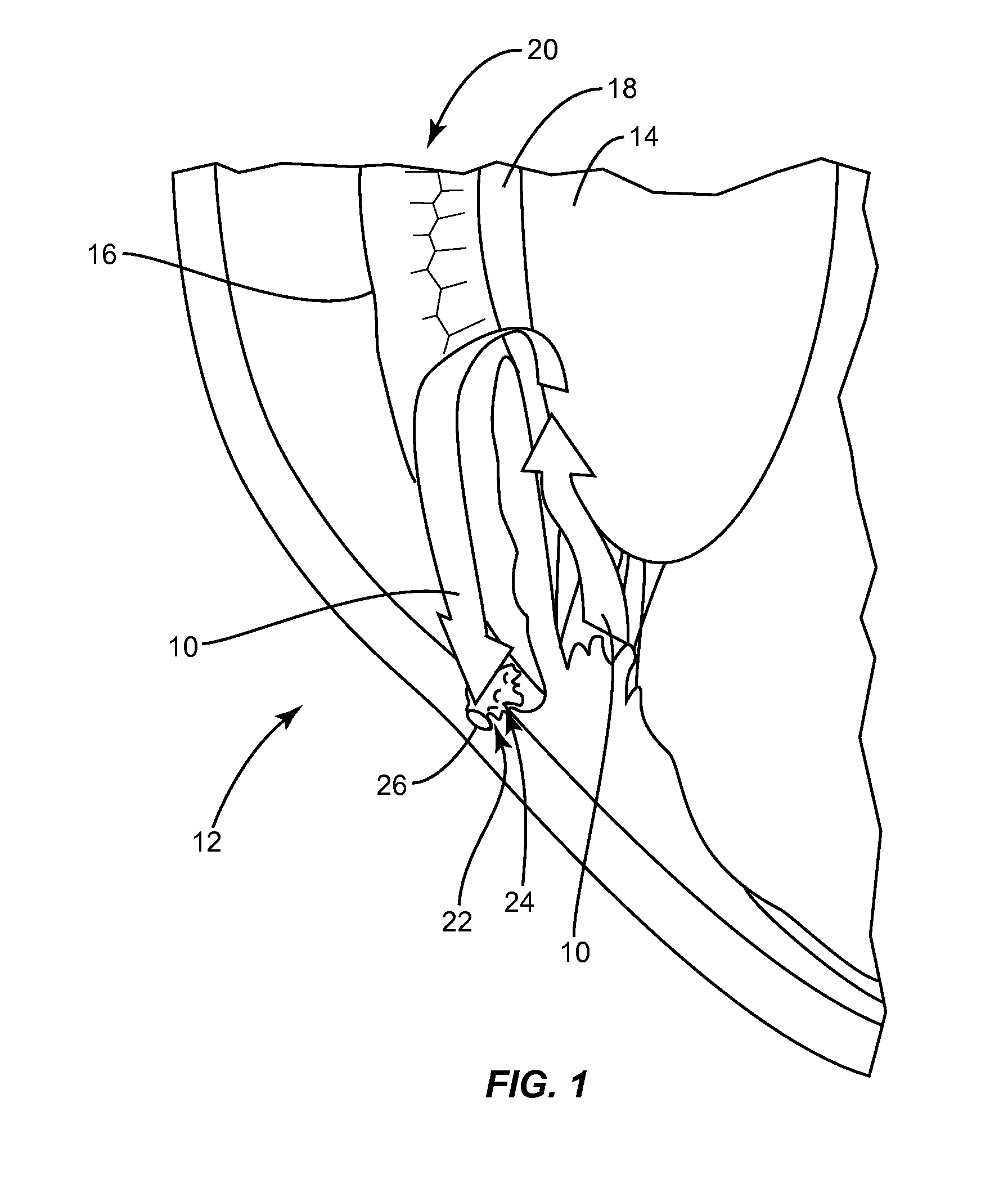 Methods, apparatuses, and systems for reducing intraocular pressure as a means of preventing or treating open-angle glaucoma