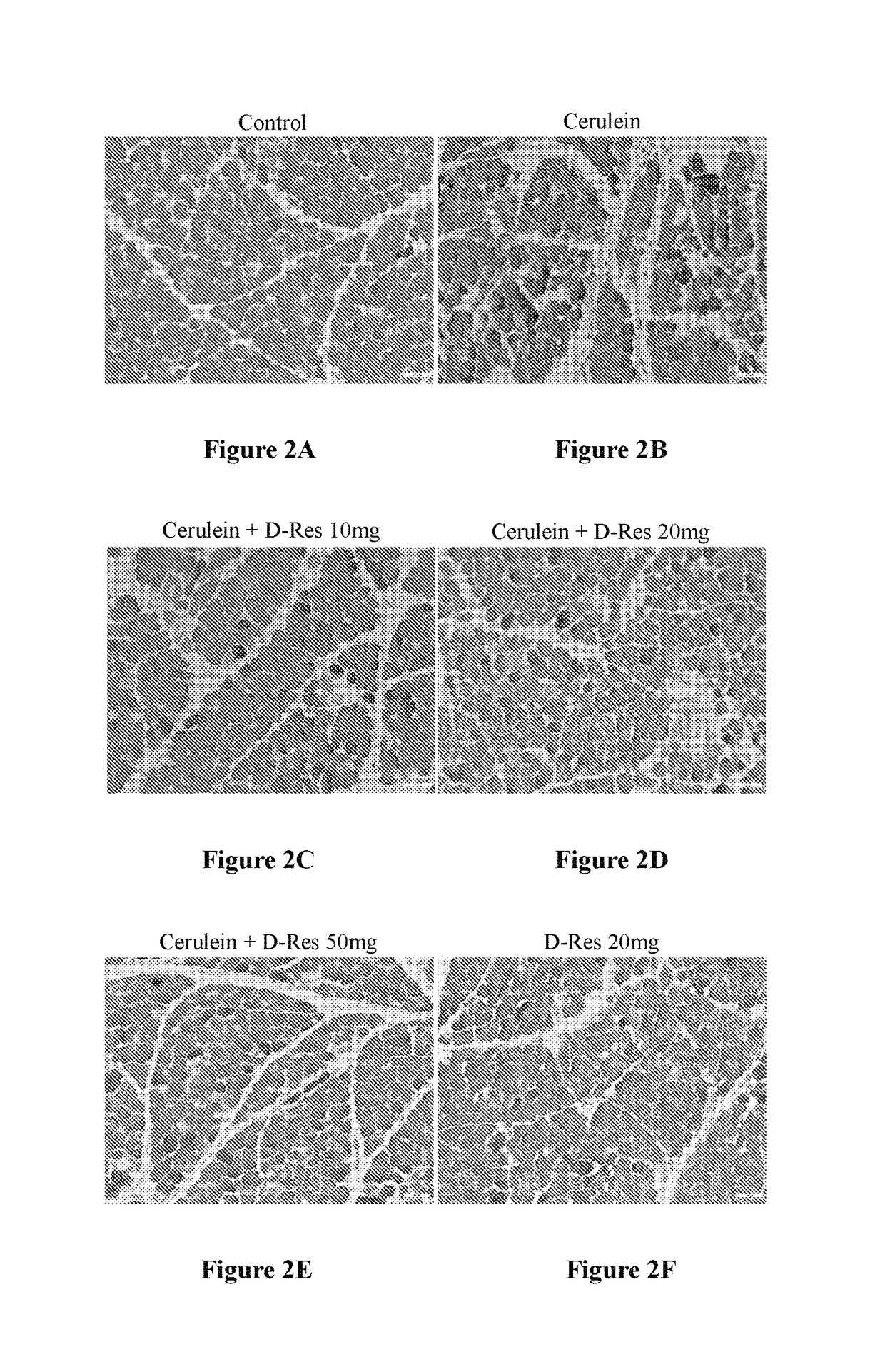 Method of using dihydro-resveratrol or its stilbenoid derivatives and/or chemical variants in treatments of fibrotic and diabetic conditions