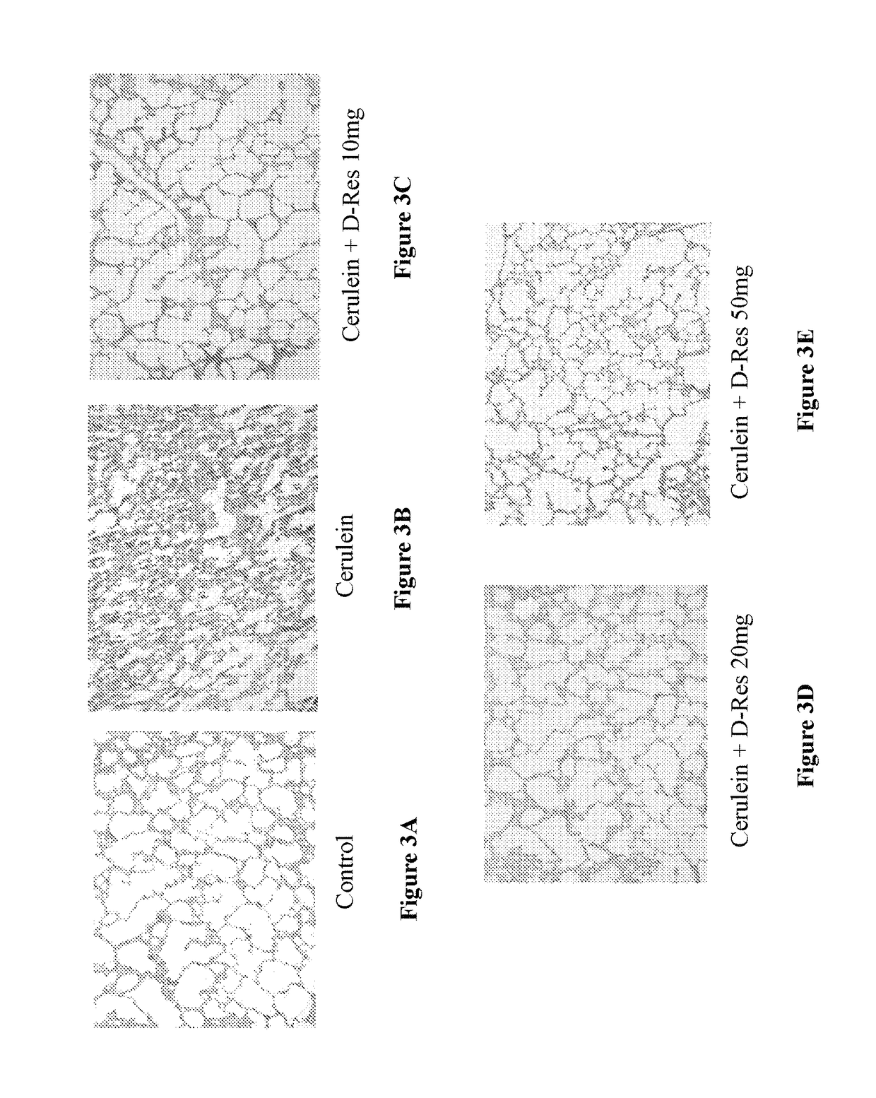 Method of using dihydro-resveratrol or its stilbenoid derivatives and/or chemical variants in treatments of fibrotic and diabetic conditions