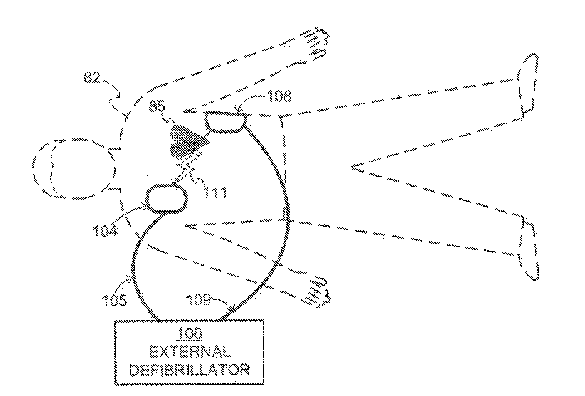 Medical monitor-defibrillator with defibrillator and data operations processors