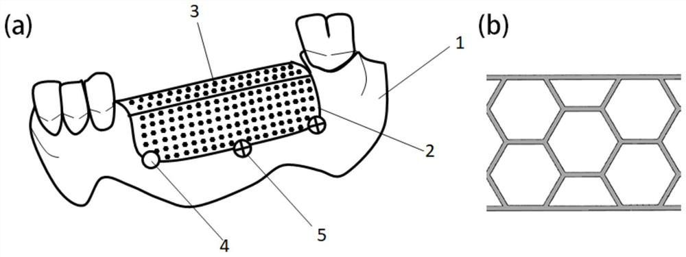 Degradable magnesium mesh for 3D printing personalized alveolar bone defect reconstruction