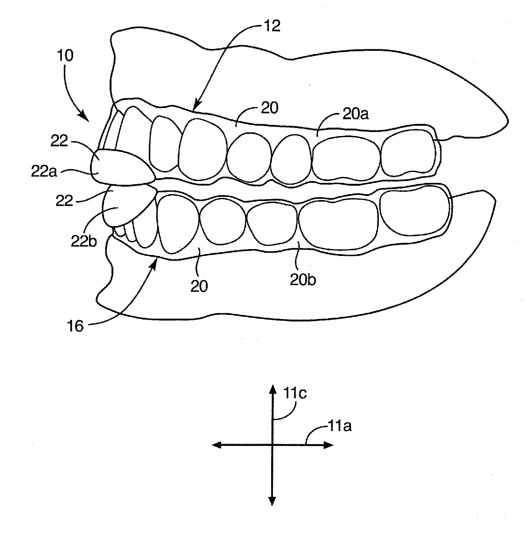 Dental appliance for treatment of bruxism