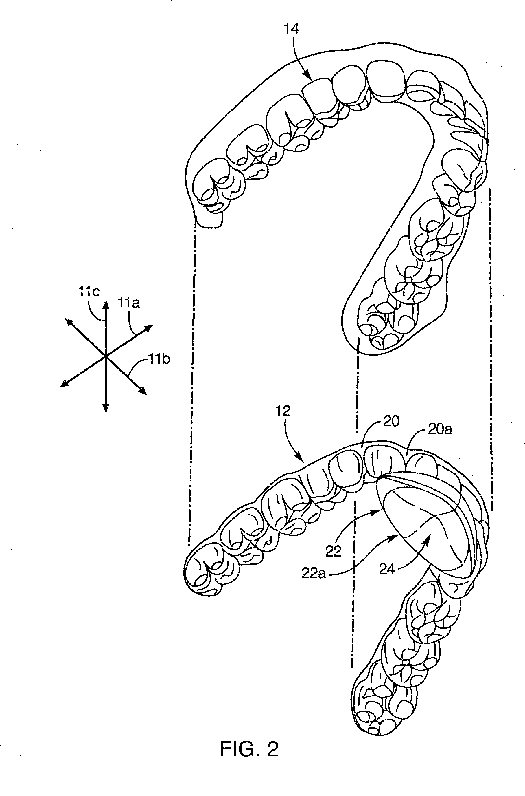 Dental appliance for treatment of bruxism