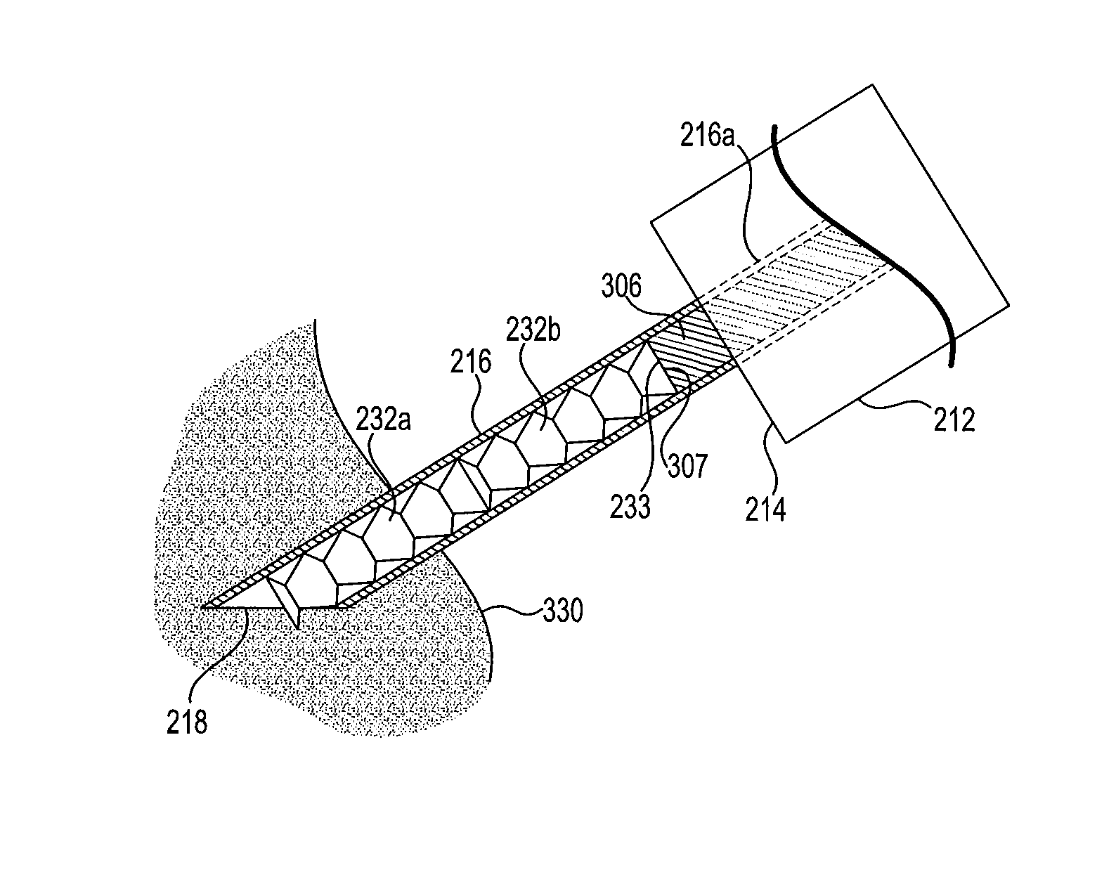 Resorbable, drug-eluting submucosal turbinate implant device and method