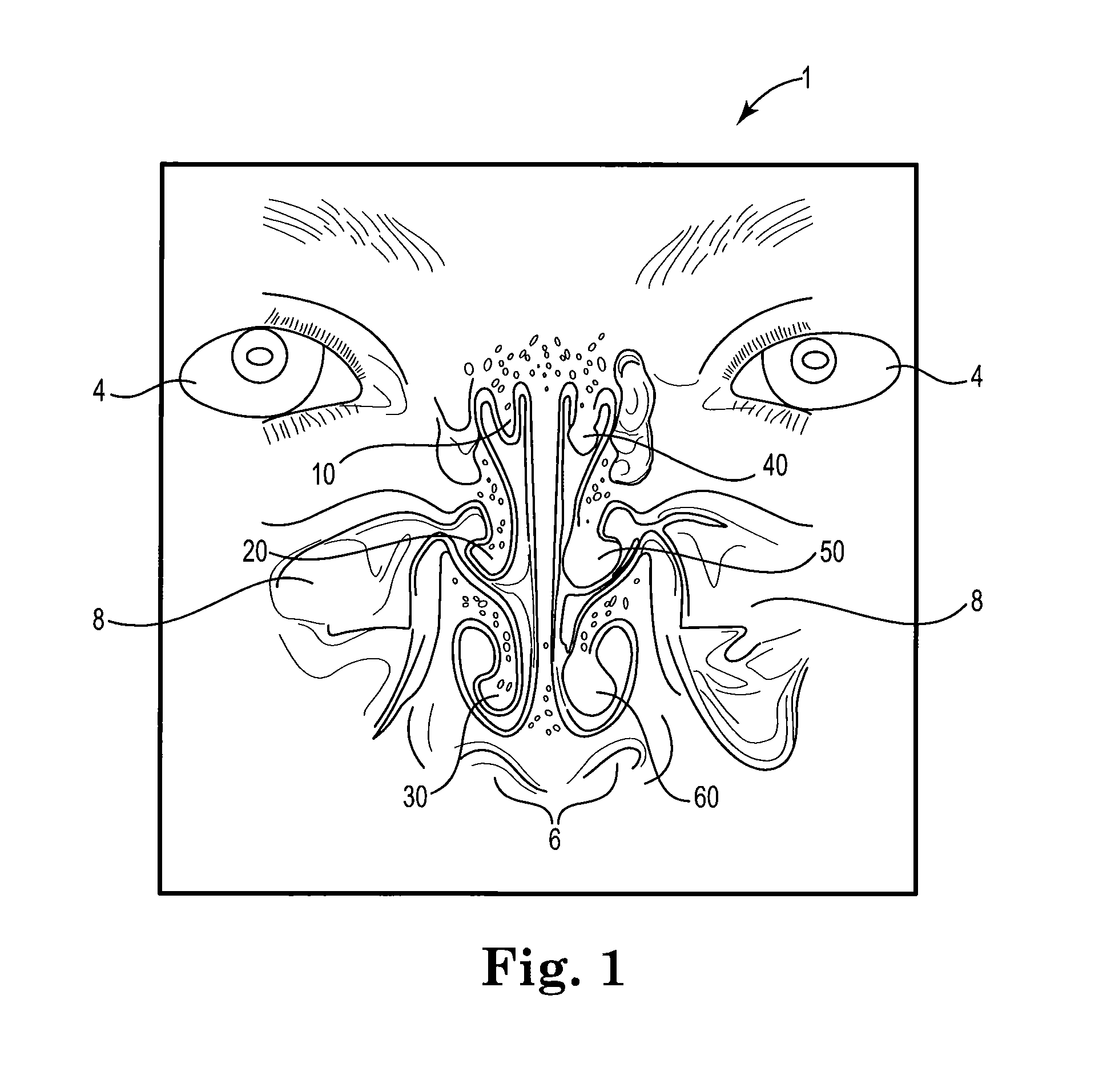 Resorbable, drug-eluting submucosal turbinate implant device and method