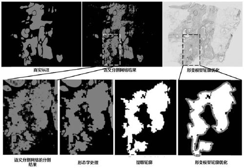 Automatic detection method and system for lesion area in pathological tissue slice image