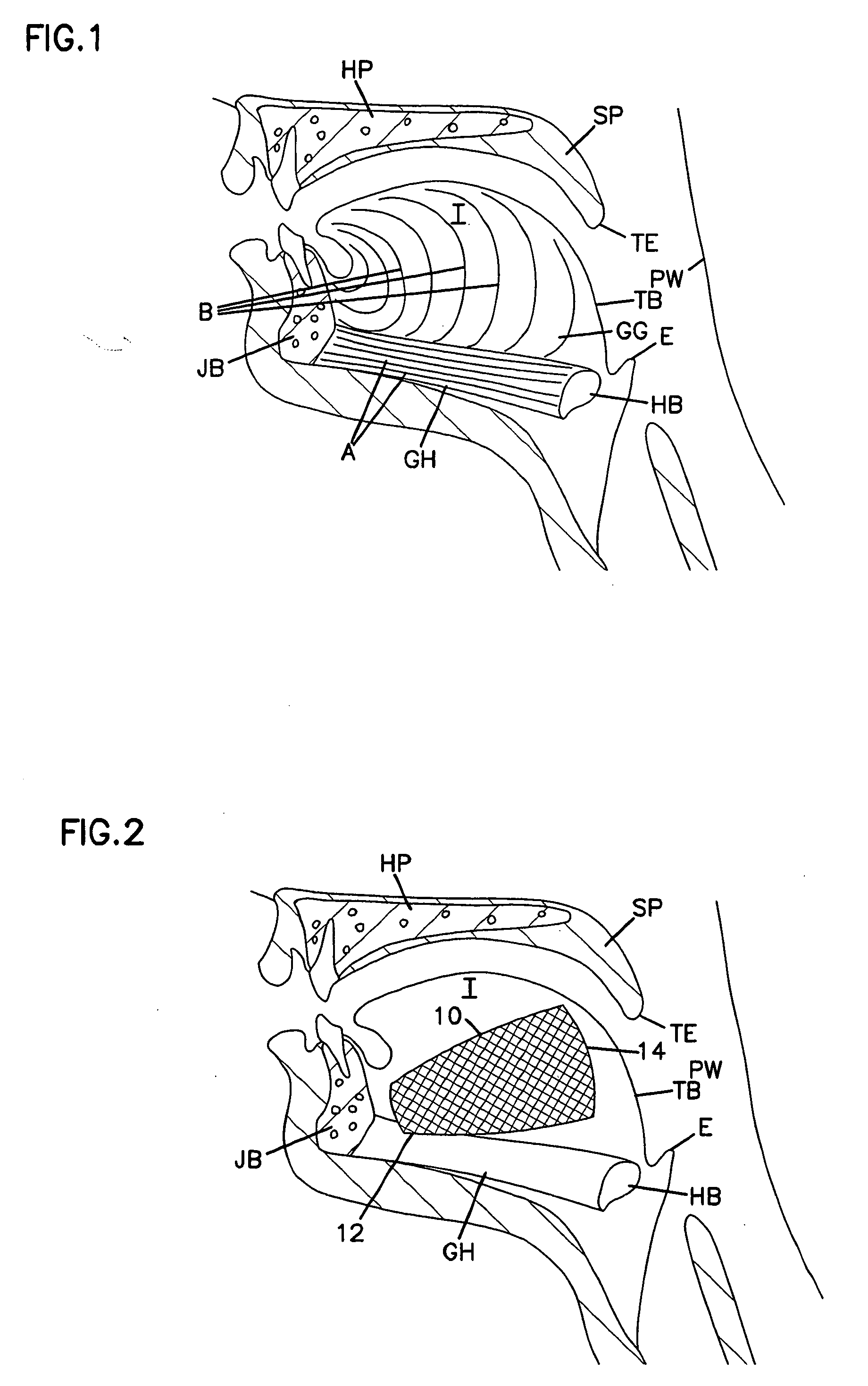 Tongue implant