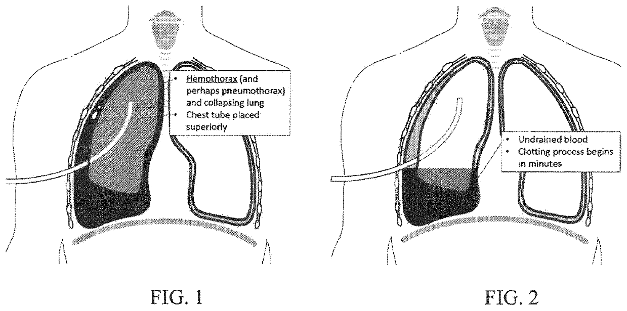 System for improving fluid drainage