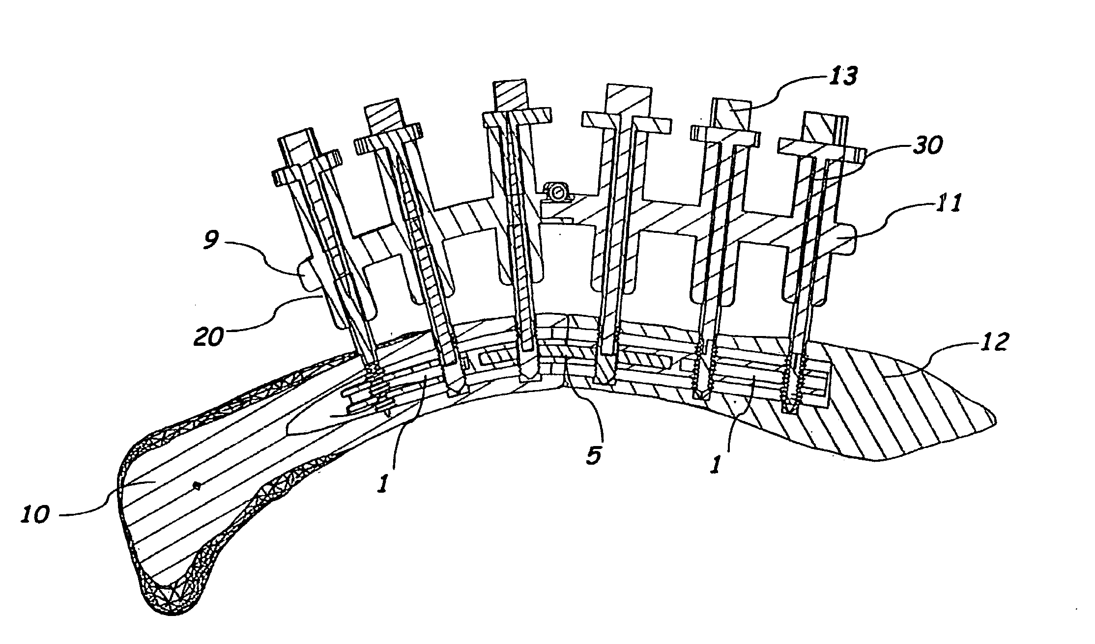 Method and system for the intramedullary fixation of a fractured bone