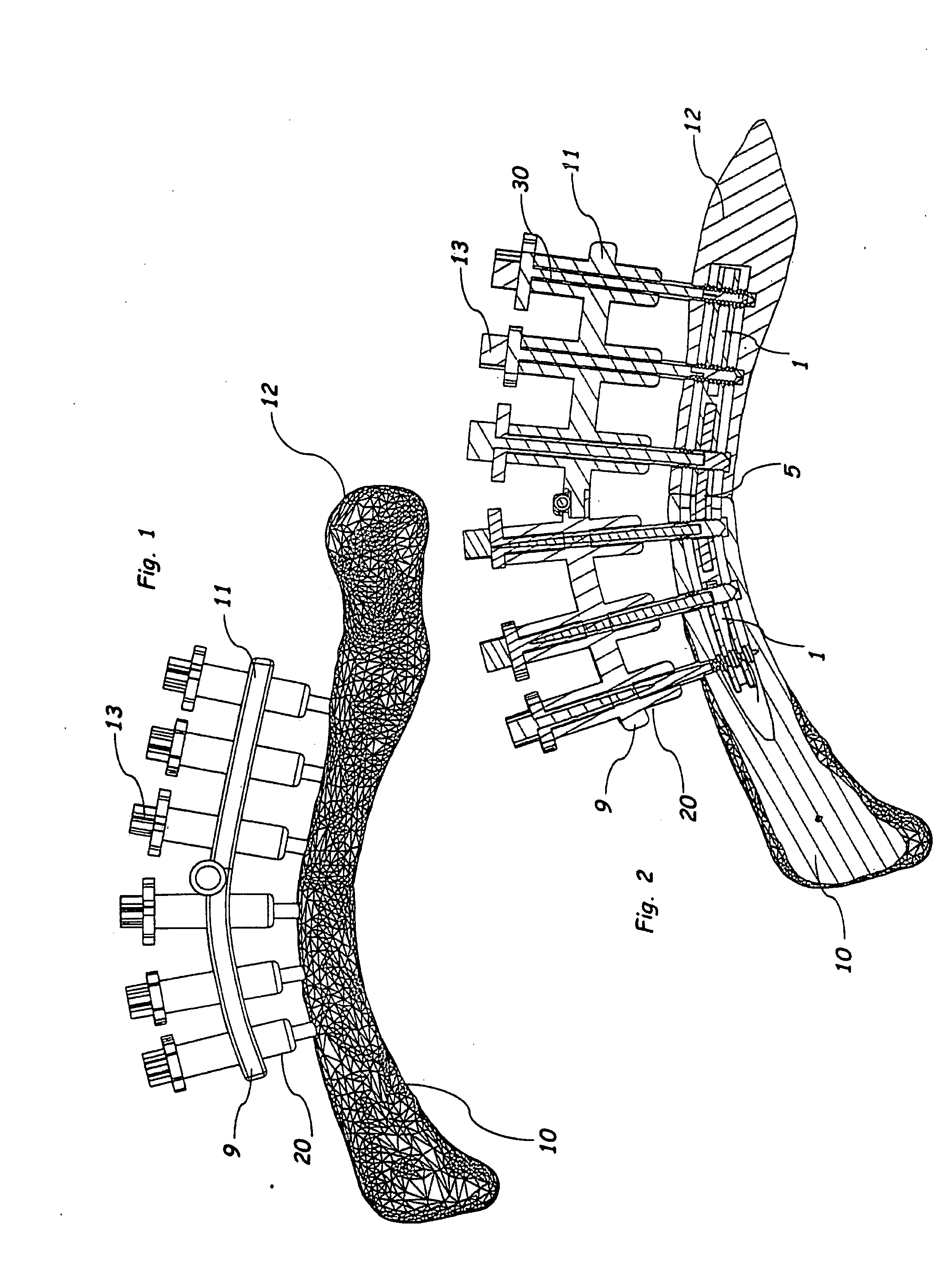 Method and system for the intramedullary fixation of a fractured bone