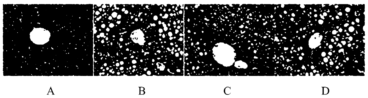 Traditional Chinese medicine composition for treating fatty liver