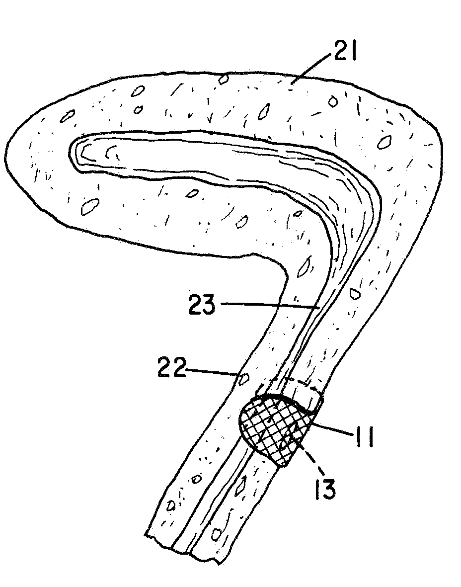 Partial cuff