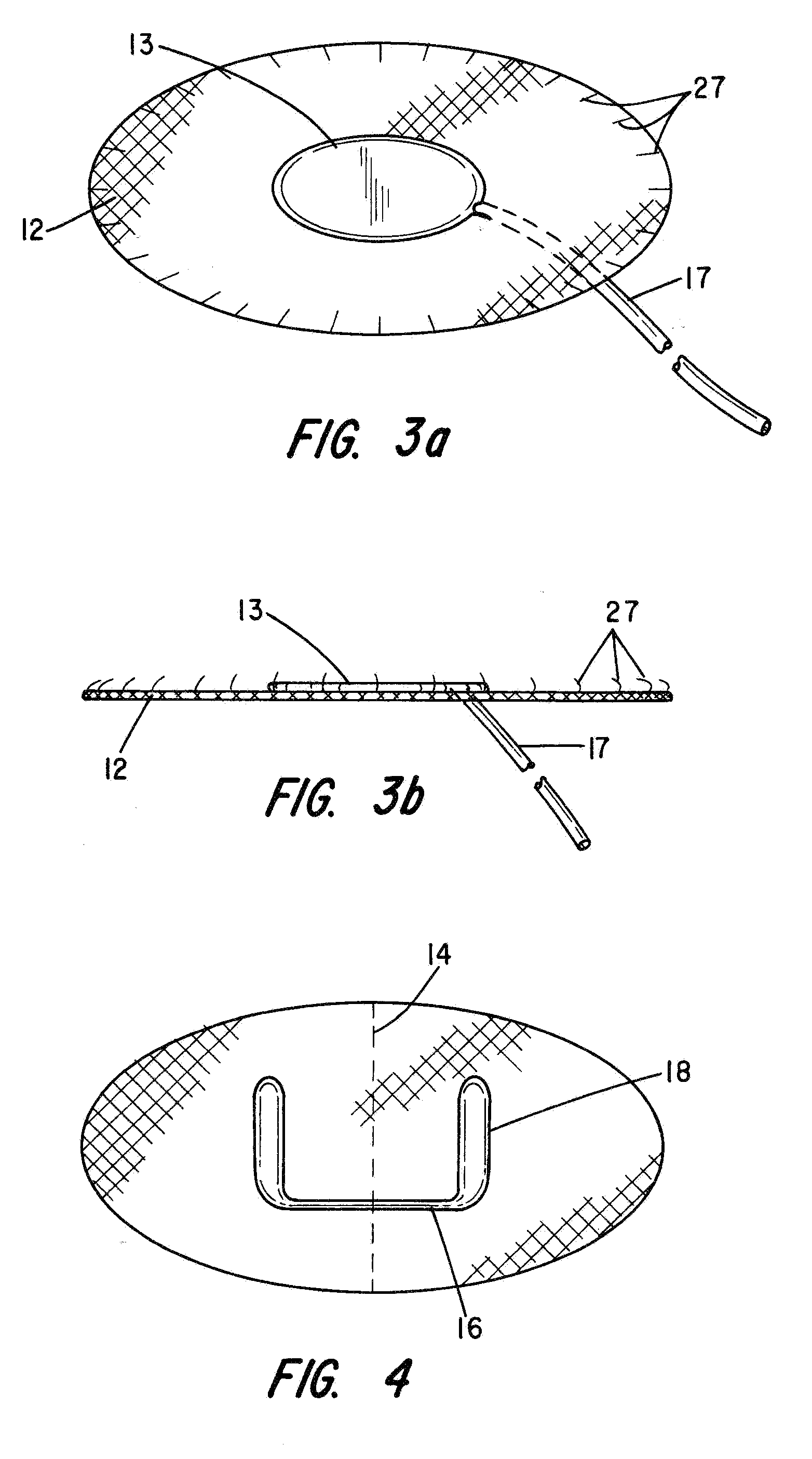 Partial cuff