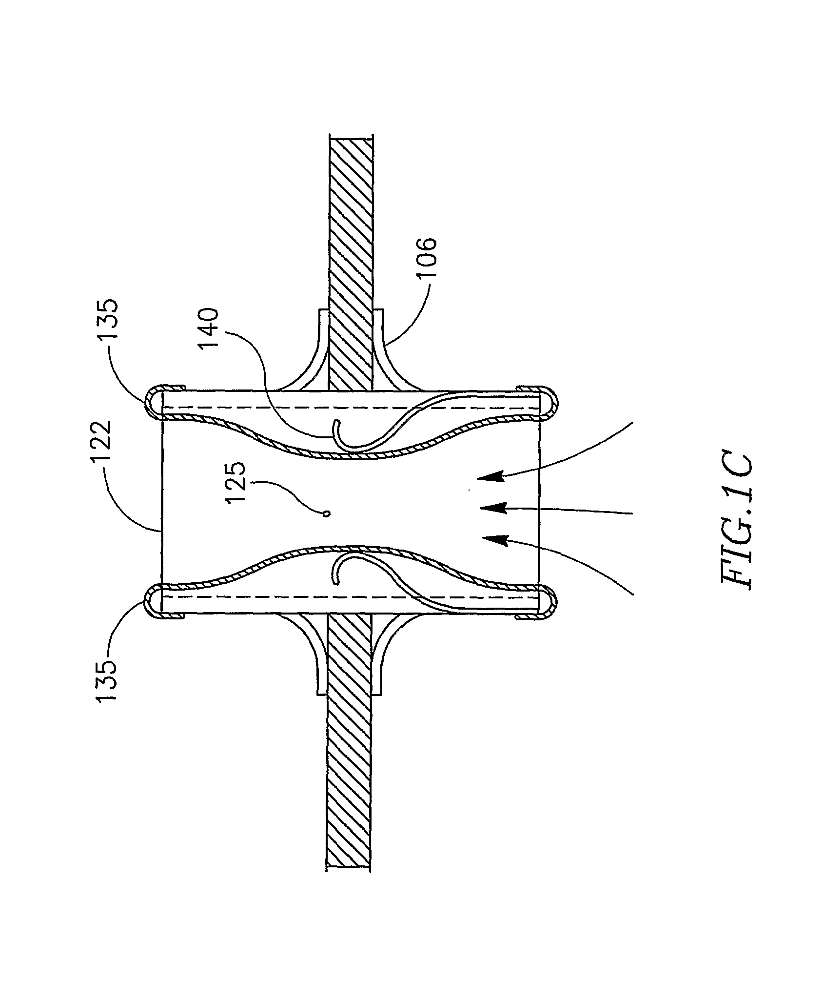 Device And Method For Controlling In-Vivo Pressure